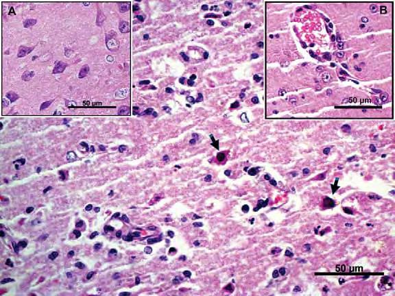 22 Figura 3. Fotomicrografia do encéfalo de coelho experimentalmente infectado com o BoHV-5. Coloração de H&E, 40X. Notar a presença de neurônios necróticos (setas). A.