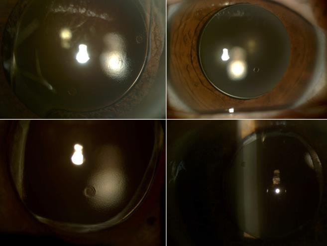 (figura 2). Figura 2 Depressões circulares dispersas na superfície da lente, observadas em 19 dos casos de opacificação.