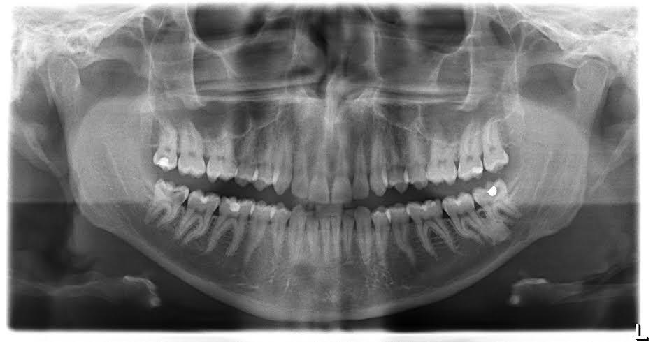 Avaliar a prevalência de anomalias dentárias congénitas (de desenvolvimento) na Clínica Universitária Egas Moniz Os resultados obtidos foram compilados numa base de dados (documento em Microsoft