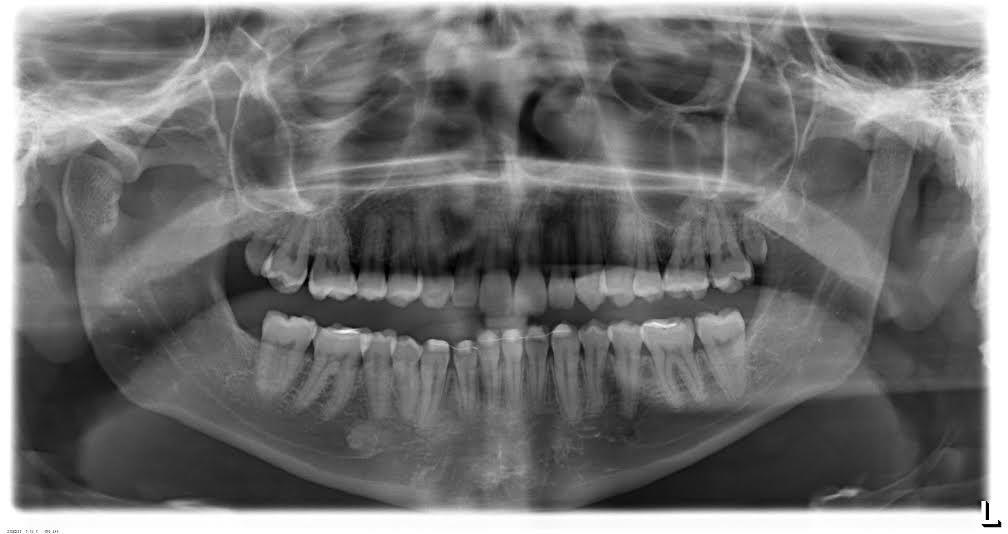 2ºpre-molares inferiores
