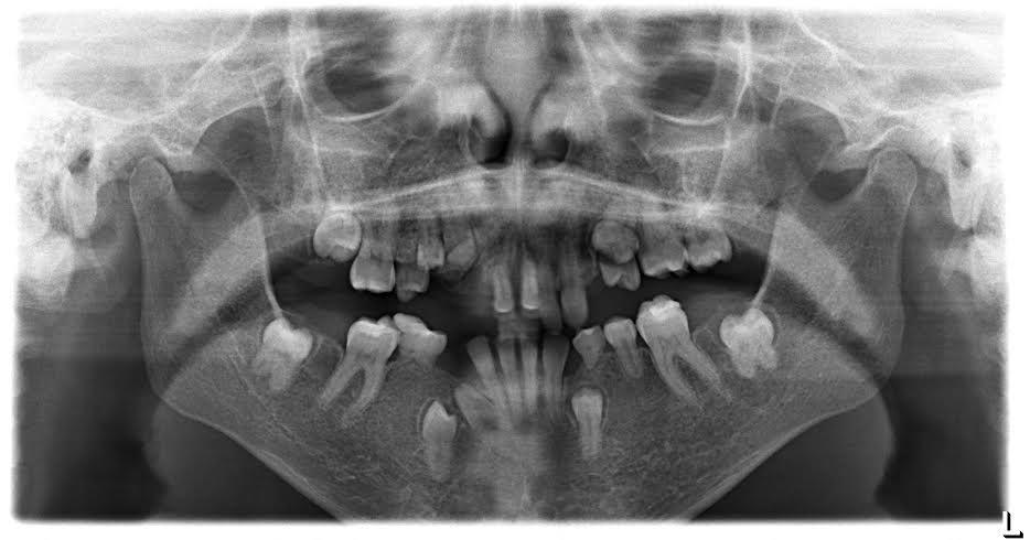 Avaliar a prevalência de anomalias dentárias