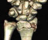 As Fraturas de Colles podem ser: 1 Oblíqua: a fratura ocorre de tal maneira, que resulta de duas partes cortantes de osso, que podem romper os tecidos e os vasos.