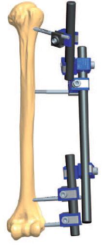 Exemplos de montagem do Fixador Externo Tubo a Tubo Easy Fix Exemplo de montagem usado em fraturas no úmero Exemplo de montagem usado em fraturas na pélvis Exemplo de montagem usado em fraturas de