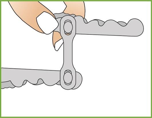 Firmar o componente de união O componente de união está unido ao pino de retenção com a férula do maxilar inferior e superior.