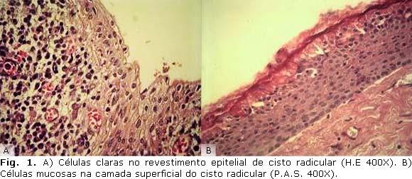 Cístico Calcificante Tumor Odontogênico Ceratocístico Tumor Odontogênico Epitelial Calcificante 1 50 2 100 - - 1 100 Dentre as lesões coradas pelo PAS-D, foram observadas células mucosas (PAS +) em