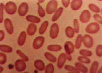 4: Policromasia na anemia