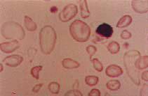 anemia falciforme Fig.