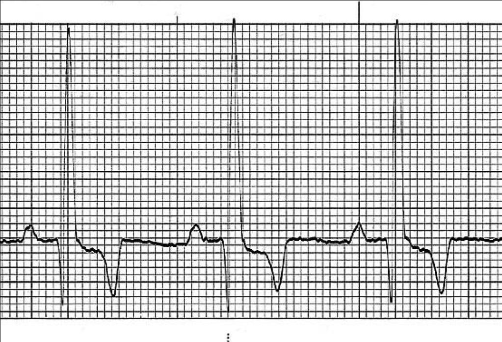 Electrocardiografia O electrocardiograma (ECG) de animais com DAP grandes apresenta-se quase sempre anormal, ajudando a confirmar o aumento das câmaras cardíacas (Kienle e Kittleson, 2006).