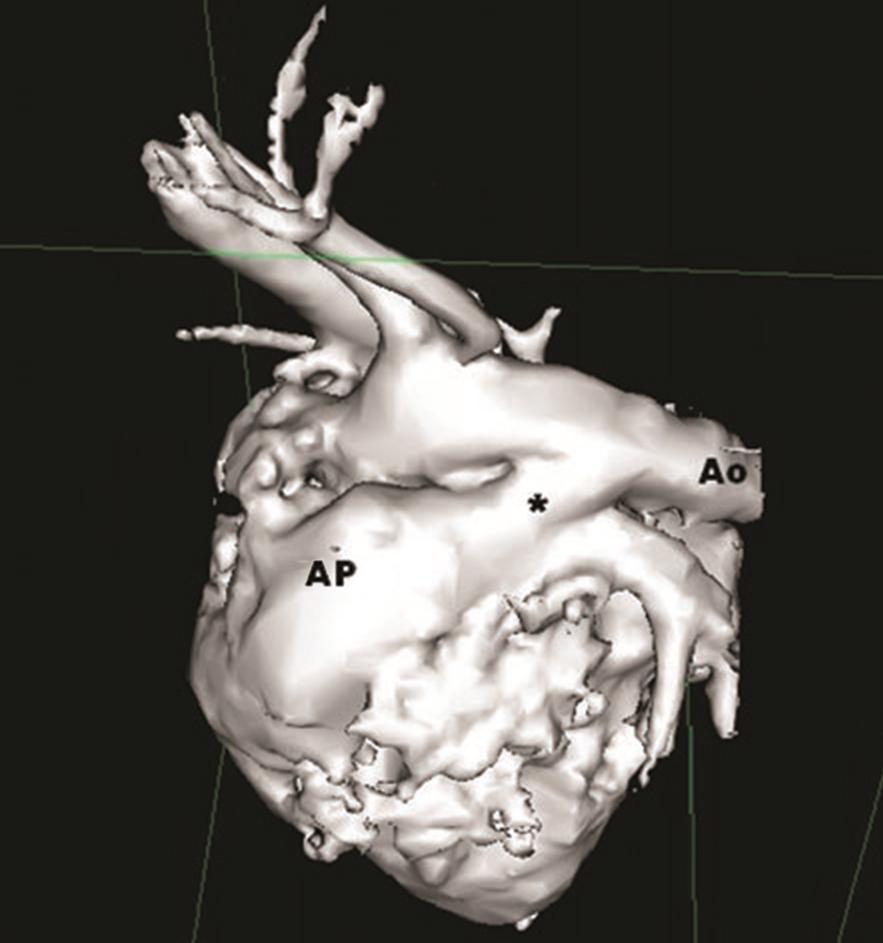 Figura 5 Reconstrução tridimensional do DAP, com recurso a ressonância magnética. O DAP estabelece comunicação entre a aorta dorsalmente e a artéria pulmonar principal ventralmente.