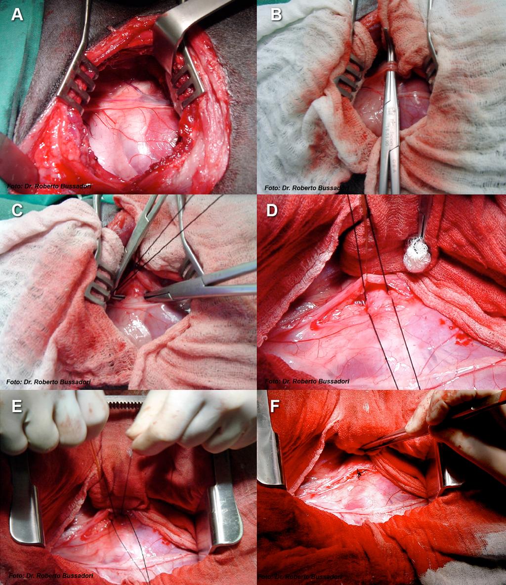 Figura 7 Técnica de disseção standard cirúrgica do DAP. Imagens gentilmente cedidas pelo doutor Roberto Bussadori.