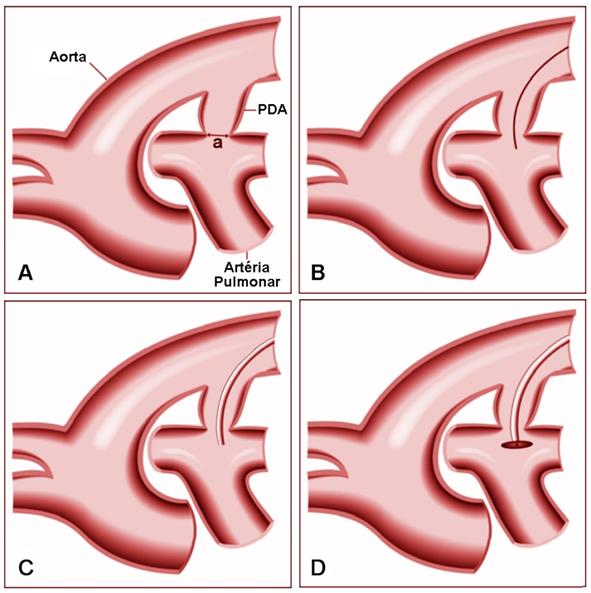 Figura 13 Representação esquemática das diferentes fases da oclusão transarterial do ducto arterioso persistente com Amplatzer Canine Ductal Occluder.