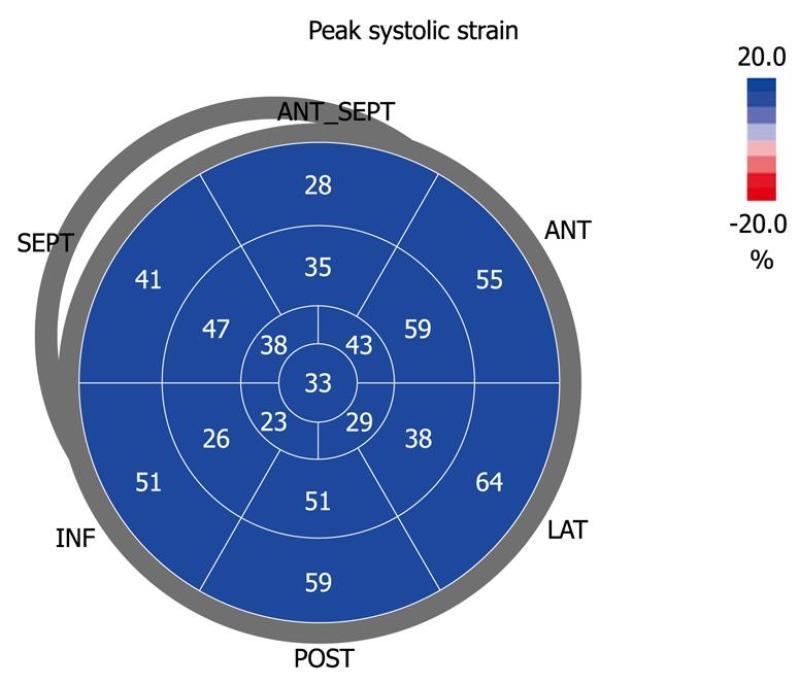 29 FIGURA 7 - Imagem em bull s eye com os valores do strain dos 17 segmentos do ventrículo esquerdo. A média de todos os segmentos constitui o strain global. Fonte: BLESSBERGER; BINDER, 2010 2.