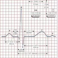 18 Figura 6 - Papel Eletrocardiográfico Fonte: http://www.electrocardiografia.es/ondas_ecg.