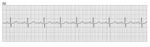 32 Tabela 5 - Descrição do traçado cardíaco, eletrocardiograma normal Definições Frequência cardíaca (FC) 50bpm e 100bpm (adultos) Métodos de Cálculo FC: 1.