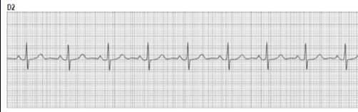 33 Definições Complexo QRS Presentes em todos os ciclos cardíacos, onda com três deflexões ou mais, despolarização ventricular; Característica morfológica: com deflexão espiculada estreita, sendo a