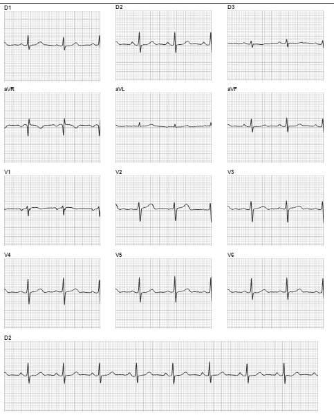 39 Figura 17 - Eletrocardiograma normal. SRG, 48 a., fem.