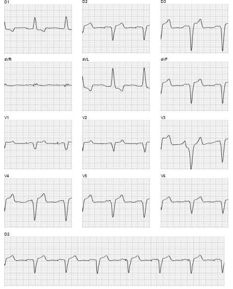 69 A localização do MP atrial gera uma espícula seguida por uma onda P e um complexo QRS normal Figura 39.