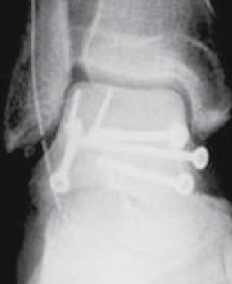 Para a reconstrução das deformidades do corpo do tálus, a incisão começou na tuberosidade do osso navicular e expôs o colo do tálus.