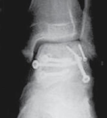 Figura 1g. No acompanhamento aos 2 anos, a radiografia lateral apresentou união sólida do tálus sem degeneração das articulações periféricas. Figura 2A.