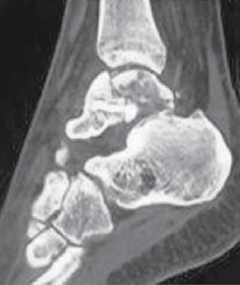 Figura 2C. A TC sagital mostrou presença de NAV talar. Figura 2E. A radiografia lateral pós-operatória mostrou correção favorável do mal alinhamento do tálus. Figura 2D.