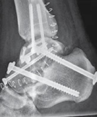 No acompanhamento de 21 meses, a radiografia ântero-posterior mostrou união sólida do tálus e artrodese total da articulação subtalar.