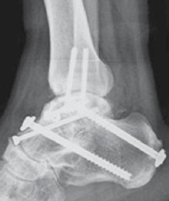 Figura 2G. No acompanhamento de 21 meses, a radiografia lateral mostrou união sólida do tálus e artrodese total da articulação subtalar. Tabela 2.