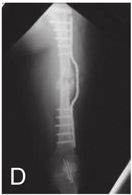 Swiontkowski 17 considerou adequado o tratamento das fraturas do colo com parafusos e o da diáfise com haste intramedular. Em 1985, Barquet et al.