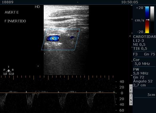 Figura 3. Ultrassonografia com Doppler espectral (PW) da artéria vertebral esquerda (AVERT E) apresentando inversão completa do fluxo sanguíneo, compatível com roubo da artéria subclávia.