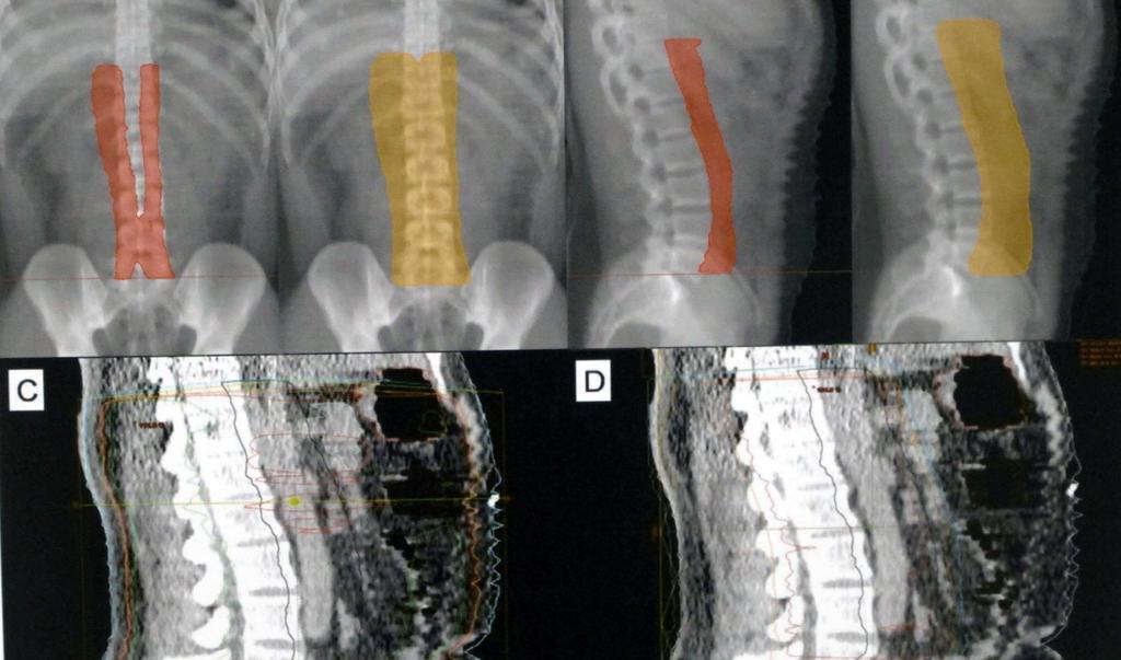 Para-aortic Nodal Clinical Target Volume Delineation in the Era of Particle Therapy C. B. Simone, J. O Connell, S.