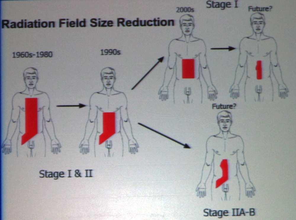 Mapping Patterns of Nodal Metastases in Seminoma: Rethinking the