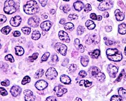 À esquerda: imagem de grande ampliação, onde se observa predominância de centrócitos (núcleo grande, citoplasma escasso), num LF de grau 1.