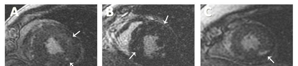 Resultados 36 Figura 11 - Imagens de realce tardio miocárdico de diferentes pacientes portadores de doença valvar aórtica grave. A.