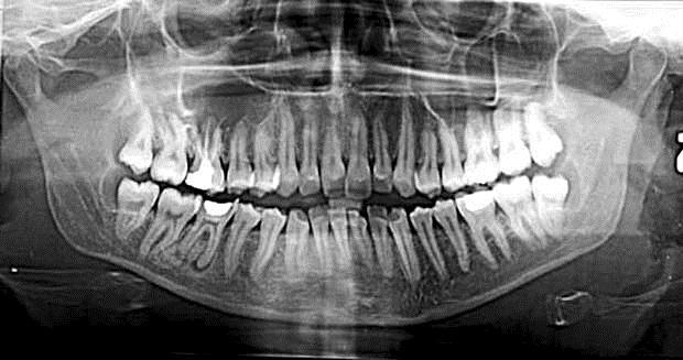 Introdução Princípios da Ortopantomografia (Paatero, 1961). Radiografia panorâmica.