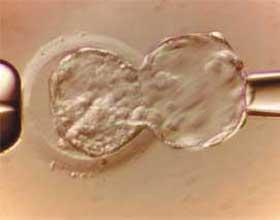 Diagnóstico genético pré-implantacional Preimplantation Genetic Diagnosis (PGD) Fertilização In vitro 3o dia - Estagio de 6 a 8 células 5o dia - blastocisto Estudos moleculares