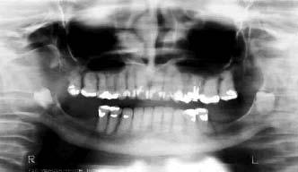Santos JS, Melo MFB, Lima JLO INTRODUÇÃO O cisto dentígero é uma entidade patológica que se forma a partir de um dente não erupcionado e origina-se da proliferação do epitélio reduzido do esmalte.