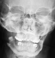 Depois do radicular, os dentígeros são os mais frequentes cistos odontogénicos diagnosticados, perfazendo 20% de todos os cistos mandibulares.