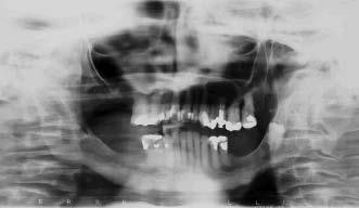 Em casos, onde o cisto atinge grandes dimensões, pode ser observada expansão da cortical óssea e dor (2). Os dois principais métodos de tratar o cisto dentígero são a enucleação e a marsupialização.