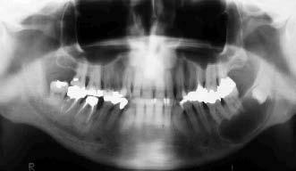Cisto Dentígero em Pacientes Geriátricos: Relatos de Dois Casos Clínicos com acompanhamento de 5 Anos unidade dentária 38.