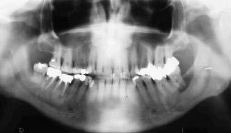 O exame radiográfico mostrou lesão osteolítica, medindo cerca de 4,5 x 2,0 cm, na região de corpo e ramo ascendente da mandíbula esquerda, associada à unidade 38 que se encontrava deslocada (Figura