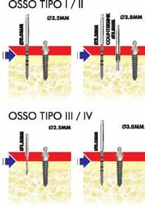 5 mm Utilização da fresa helicoidal Ø1.5mm até sua total extensão de profundidade. Essa fresa Helicoidal de Ø 1.