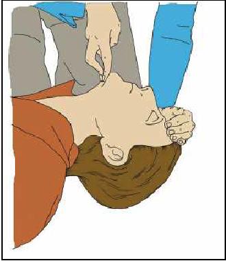 Coloque o talón 5) Inclínese sobre a vítima, cos brazos rectos. Prema verticalmente no peito ata deprimilo 4 ou 5 cm. Libere a presión e deixe que o peito se recupere, pero non retire as mans.