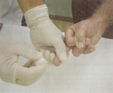 Sustente a mão esquerda do paciente, com a palma para baixo e selecione o terceiro dedo a partir do polegar ou o dedo indicador,