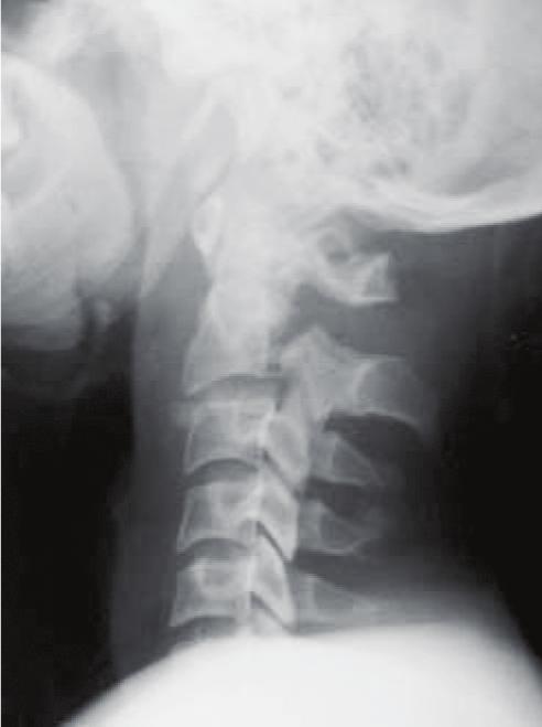 10 e, posteriormente, modificada por Levine e Edwards 11, que incluiu o mecanismo de trauma na classificação (inferido através de parâmetros radiográficos bem definidos).