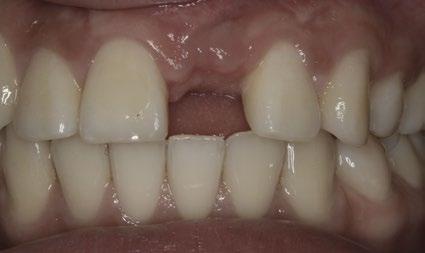 Taxas de sucesso e sobrevivência do implante Straumann PURE Ceramic depois de acompanhamento de 1 ano em um estudo multicêntrico11 Sobrevivência Êxito 97,6 % 97,6 % n = 41/42 n = 41/42 Antes Depois