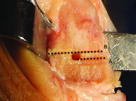 centro da cabeça. A posição lateromedial dessa perfuração determina a massa que constitui um dente ósseo e sua espessura dita a quantidade do deslocamento medial final da cabeça; 7.