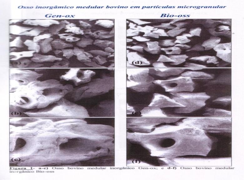GenOx Inorg Vantagens e Benefícios: Permite a manutenção do volume e arcabouço ósseo. 30% reabsorve e 70% ósseo-integra.