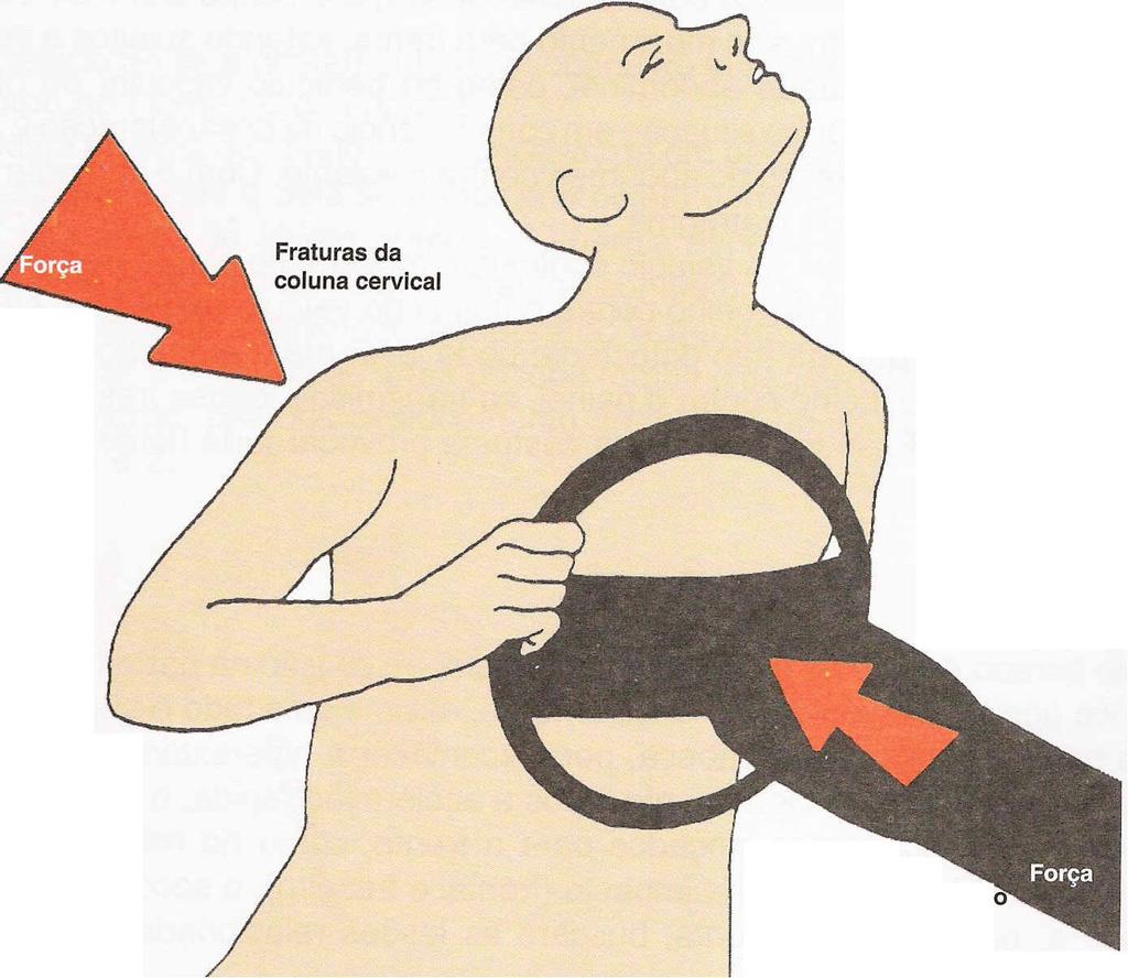 Com o aumento de pressão no abdômen, pode haver ruptura do diafragma. Fig 4.