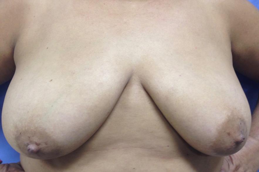 Exame Físico: ausência de alterações em mama e/ou linfonodos.
