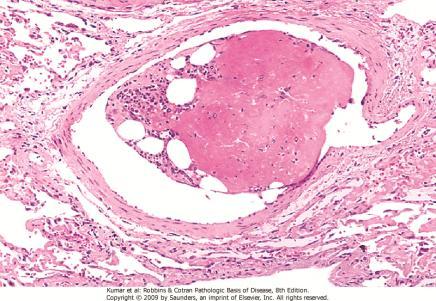 3.2. Embolia de Medula Óssea 10 3.3. Conseqüências da Embolia Dependem Vulnerabilidade do tecido a isquemia Calibre do vaso ocluído Circulação colaterais Características dos êmbolos