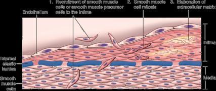 7. Arterioesclerose Estreitamento do lúmen de artérias e arteríolas Esclerose medial calcificada de Monckerberg Não são clinicamente significativas